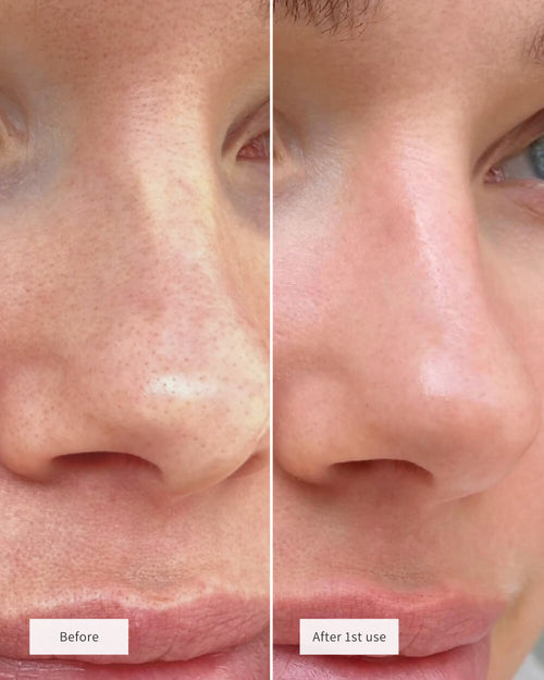 SALICYLIC ACID EXFOLIANT